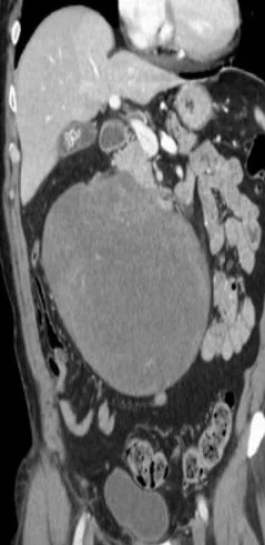 MESENTERIC DESMOID TUMOR 