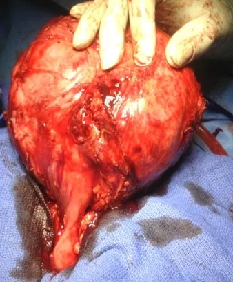 MESENTERIC DESMOID TUMOR