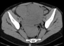 MESENTERIC FIBROIDS