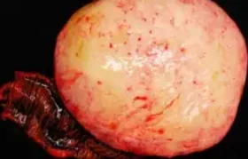 MESENTERIC FIBROMATOSIS