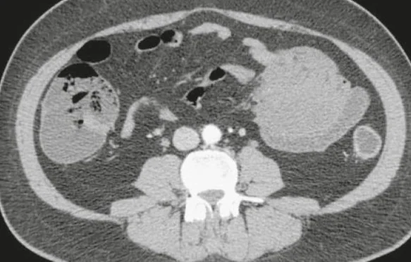 MESENTERIC FIBROMATOSIS 
