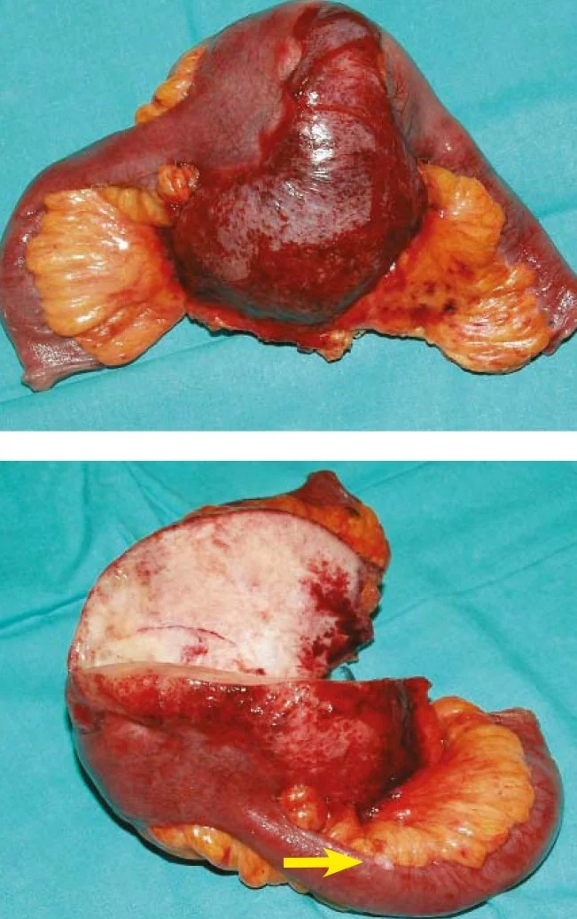 MESENTERIC FIBROMATOSIS
