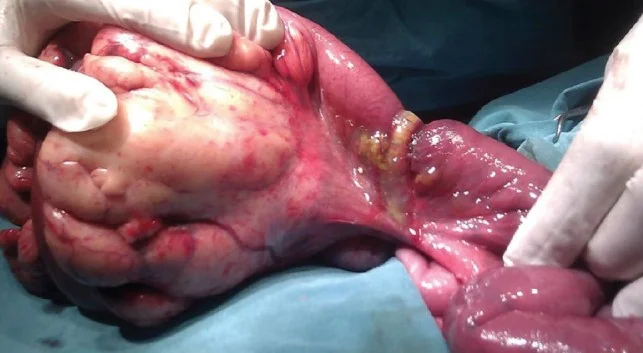 MESENTERIC LIPOMA 