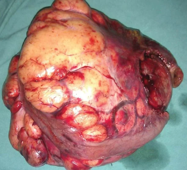 MESENTERIC LIPOMA
