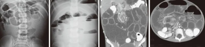 MESENTERIC LYMPHANGIOMA 
