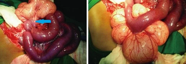 MESENTERIC LYMPHANGIOMA