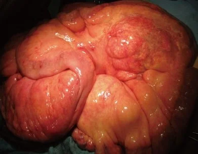 MESENTERIC MYOLIPOMA 