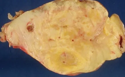 MESENTERIC MYOLIPOMA