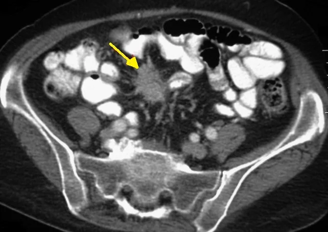 MESENTERIC NEUROENDOCRINE TUMOR 