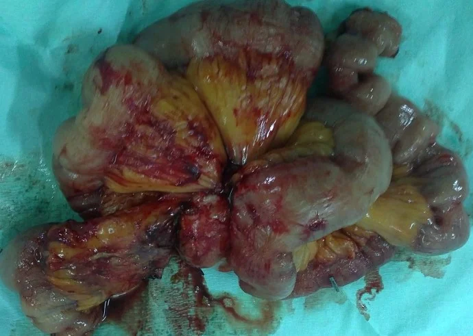 MESENTERIC NEUROENDOCRINE TUMOR