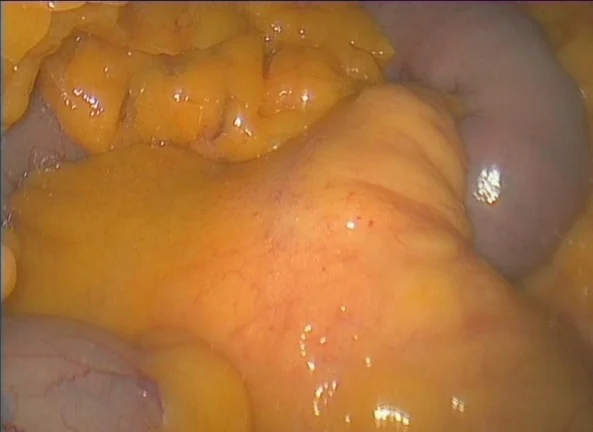 MESENTERIC PANNICULITIS 