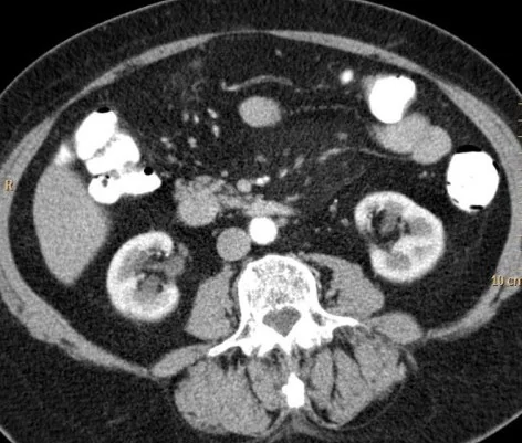MESENTERIC PANNICULITIS