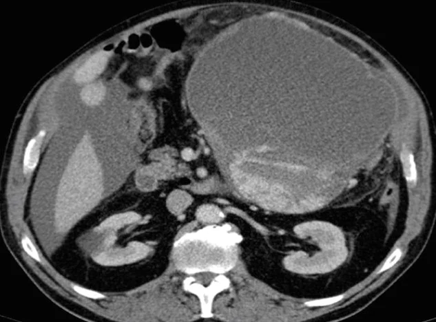 MESENTERIC STROMAL TUMOR 