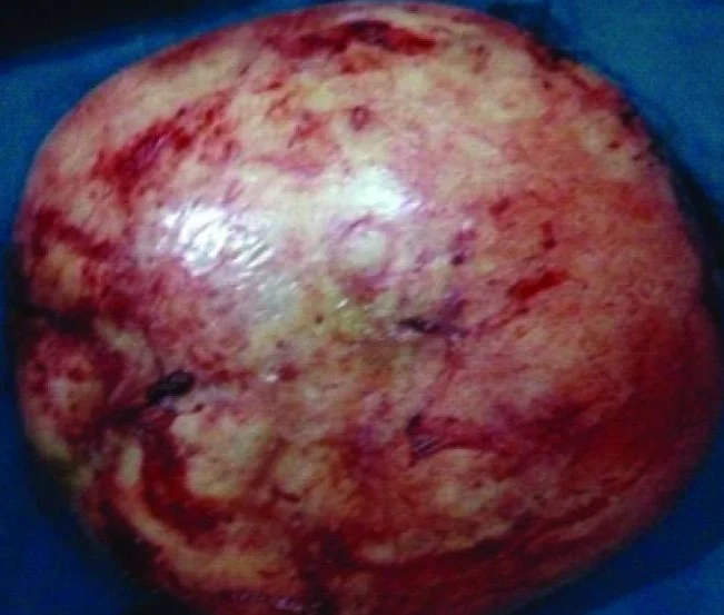 MESENTERIC TUMOR  - FIBROMATOSIS