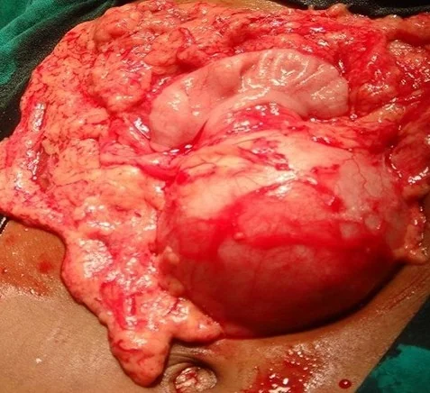 MESOCOLIC DERMOID CYST 