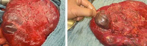 SIGMOID MESENTERY HEMANGIOMA