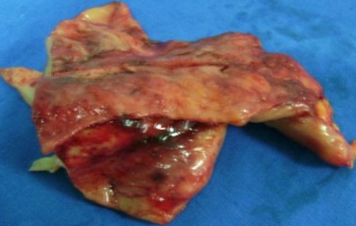 THYMOMA