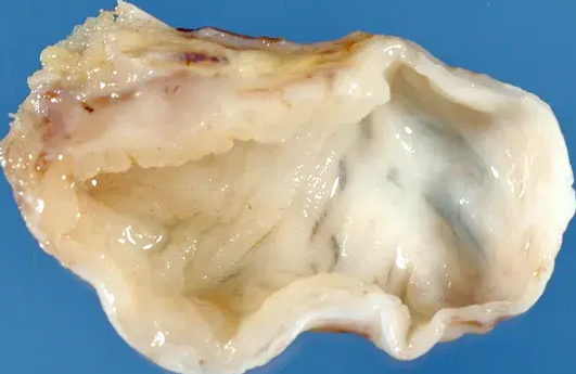 ESOPHAGEAL CYST