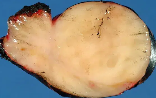 GANGLIONEUROBLASTOMA