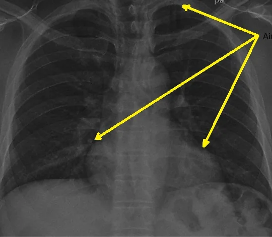 PNEUMOMEDIASTINUM
