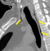 PNEUMOMEDIASTINUM