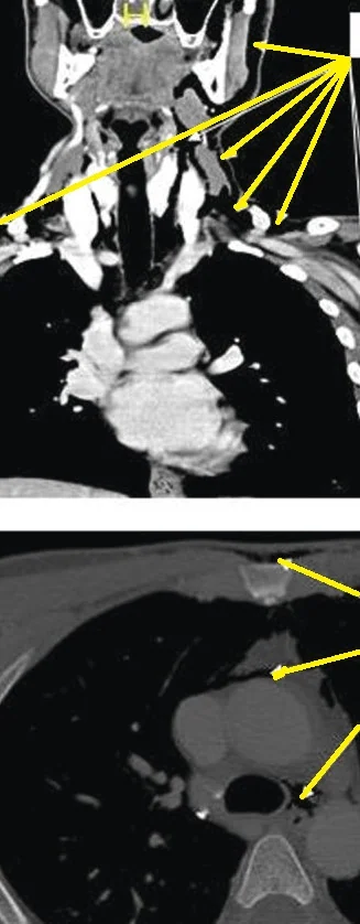 PNEUMOMEDIASTINUM