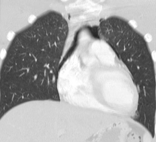 PNEUMOMEDIASTINUM 