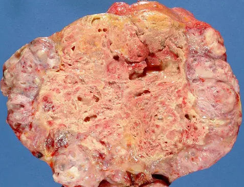 TERATOMA