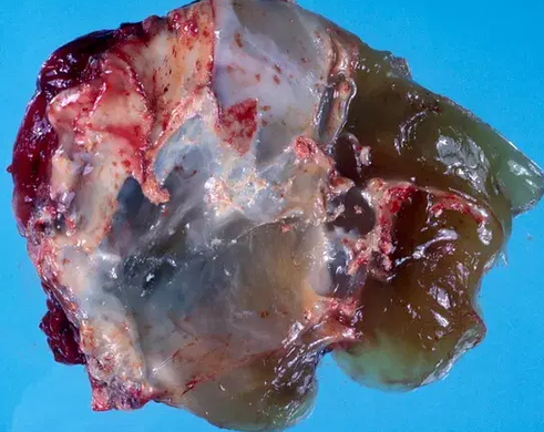 TERATOMA