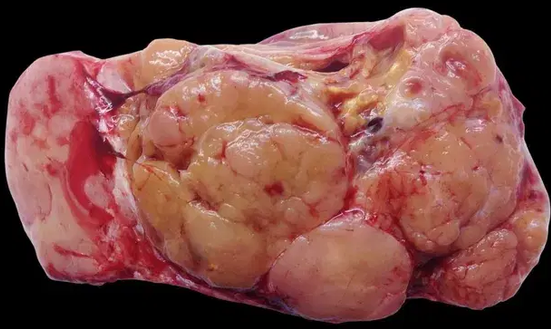 THYMOMA