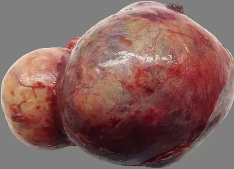 THYMOMA
