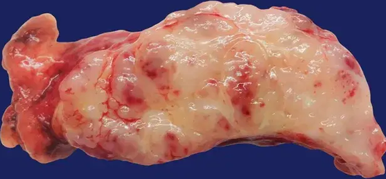 THYMOMA