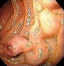BLEEDING DUODENAL VARICES 