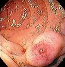 BLEEDING DUODENAL VARICES