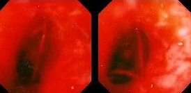 BLEEDING ESOPHAGEAL VARICES 