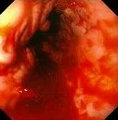 BLEEDING ESOPHAGEAL VARICES 
