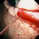 BLEEDING GASTRIC VARICES 
