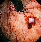 BLEEDING GASTRIC VARICES 