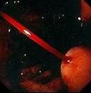 BLEEDING GASTRIC VARICES 