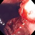 BLEEDING GASTRIC VARICES 