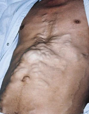 LIVER CIRRHOSIS - "CAPUT MEDUSAE".