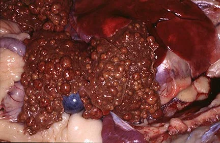 LIVER CIRRHOSIS