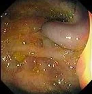 COLONIC VARIX