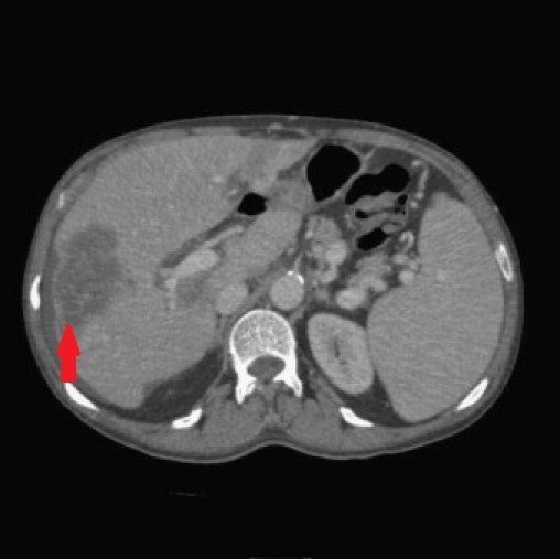 HEPATIC METASTASIS - PORTAL HYPERTENSION