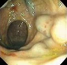 RECTAL VARICES 