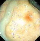 RECTAL VARICES