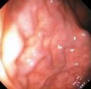 RECTAL VARICES