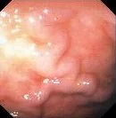 RECTAL VARICES