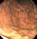 RECTAL VARICES